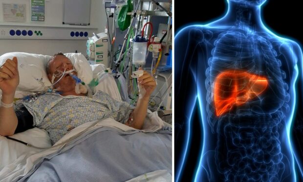 William McHaffie lying in hospital bed and on the right is a graphic of a skeleton highlighting the liver