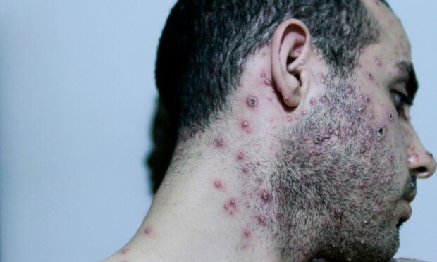 Monkeypox can sometimes be mistaken for chickenpox. Picture by Shutterstock