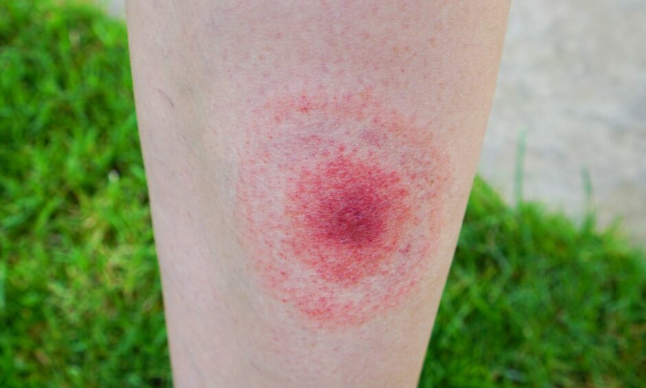A "bullseye" rash after being bitten by a tick is one of the signs of Lyme disease.