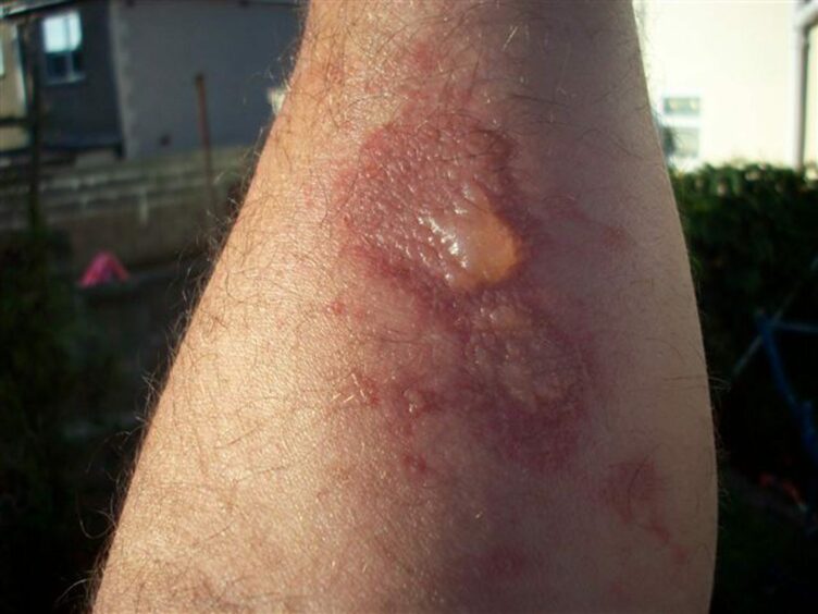 Giant hogweed burn