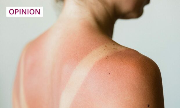 Ben Dolphin: Sunburn isn’t the badge of honour some believe it to be