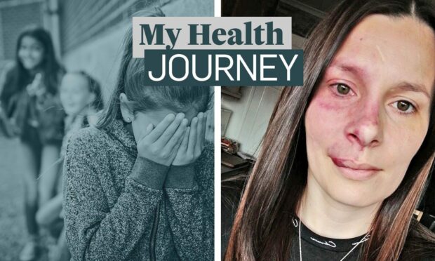 After years of bullying, Sutherland woman learned to embrace her facial birthmark