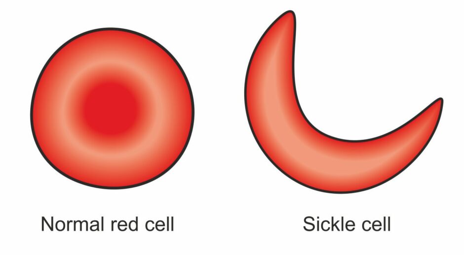 showing difference between normal and sickle cell red cells. Normal red cells are round and sickle cells are crescent shaped