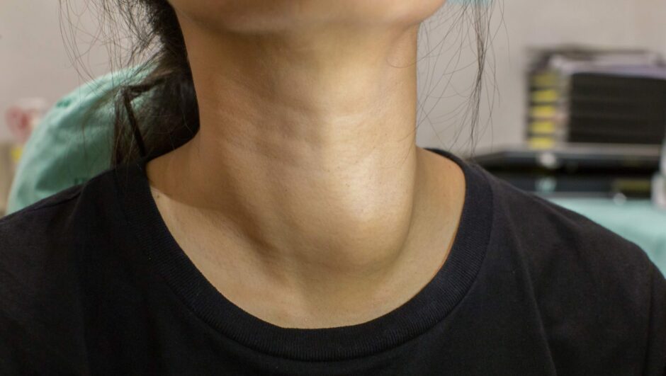 Woman with thyroid problem with swollen lump on her thyroid gland 