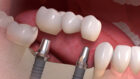 A picture of dental implant