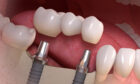 A picture of dental implant