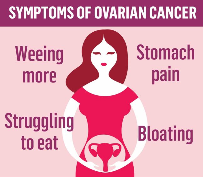 Graphic with signs of ovarian cancer. Peeing more, stomach pain, struggling to eat and bloating are common symptoms. 