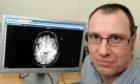 Aberdeen University's Dr Gordon Waiter next to a brain scan to look for dementia