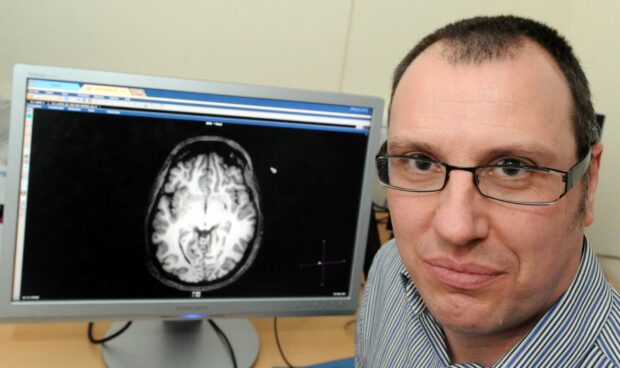 Aberdeen University's Dr Gordon Waiter next to a brain scan to look for dementia