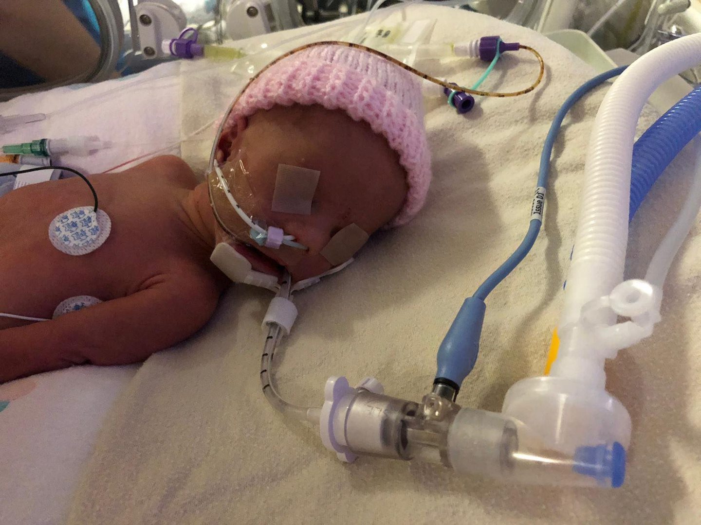 Georgia spent 32 days in the neonatal unit. Image: The Archie Foundation