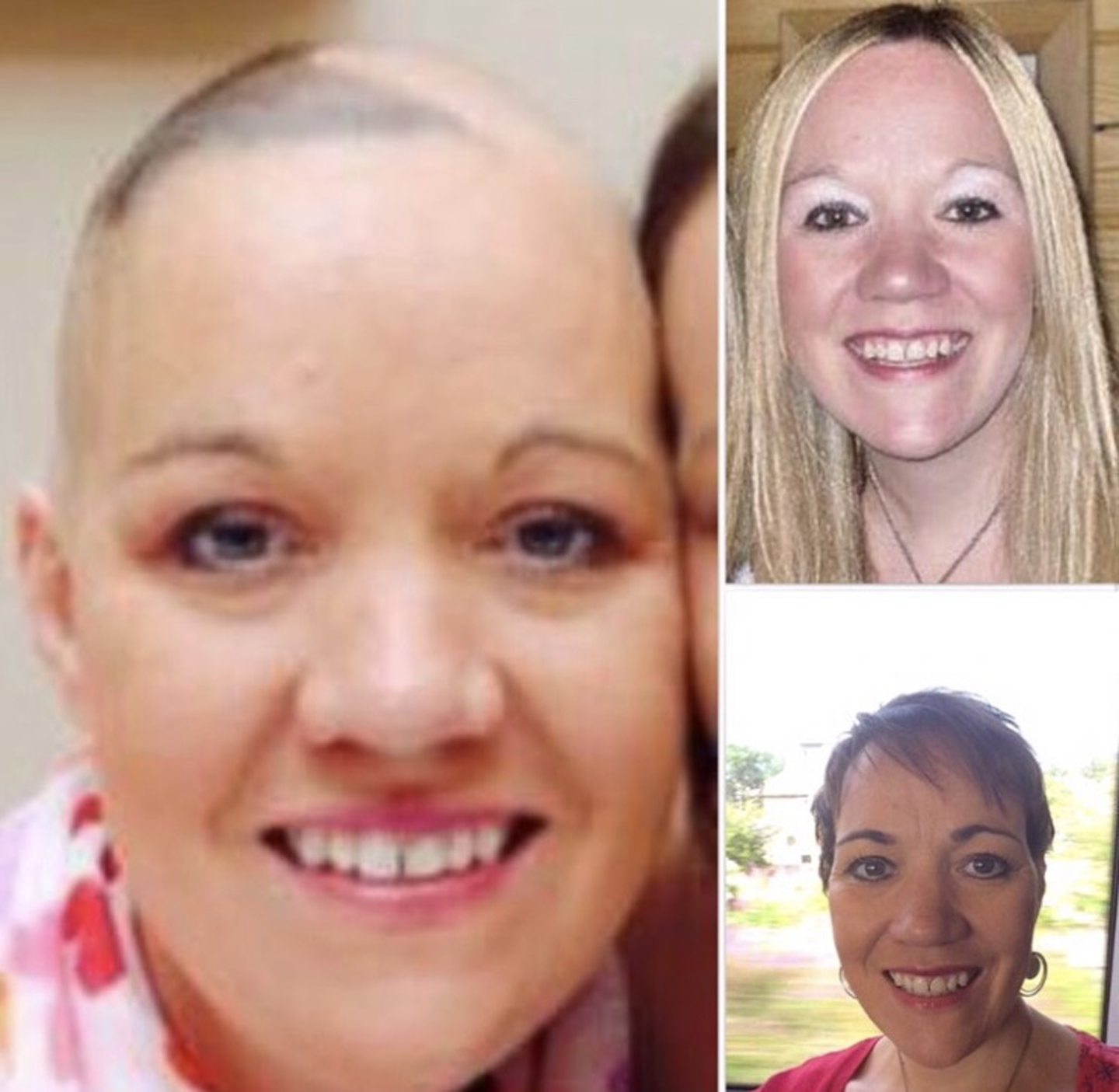 After her operation, Suzanne needed chemotherapy and radiotherapy which caused her to start losing hair - so she shaved the rest off. Image: Suzanne Davies