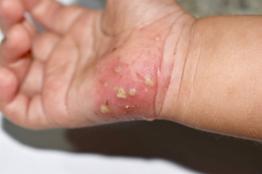 A hand infested with scabies. 