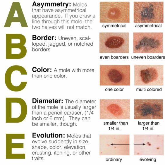 The British Association of Dermatologists ABCDE of potential skin cancer.