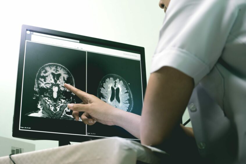 Small vessel disease and dementia on film MRI. Pic: Shutterstock.