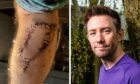 Steven Shanks needed 35 stitches in his leg but his melanoma operation will not affect the Garioch half marathon he is running later this month. Image: Wullie Marr/DC Thomson