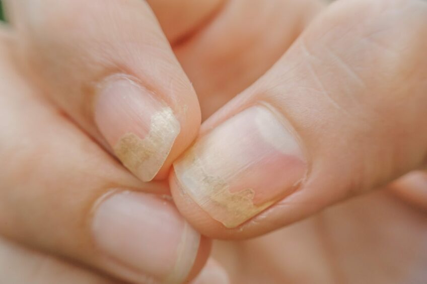 Onychomycosis, or fungal nail infection on a sufferers' thumb and forefinger.