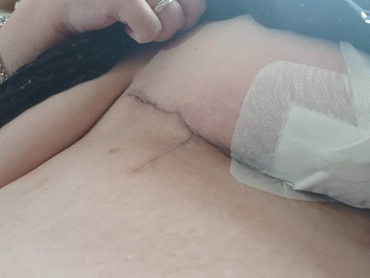 Large scar on Lerwick woman Sylvia Halcrow's torso after she recovered from necrotising fasciitis.