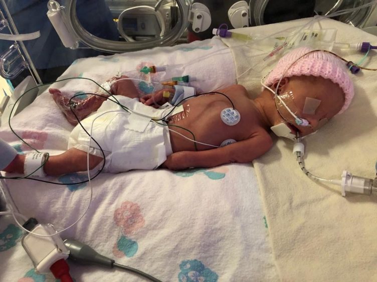 Georgia Hill lies in an incubator at Aberdeen neonatal unit