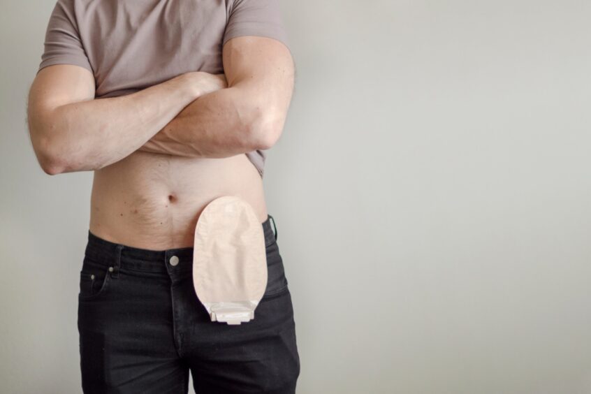 A man with a stoma bag.
