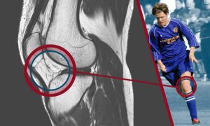 Image shows graphic of a x-ray of an anterior cruciate ligament (ACL) alongside Inverness Caley Thistle Women manager Karen Mason, whose playing career was cut short after she suffered two serious knee injuries.