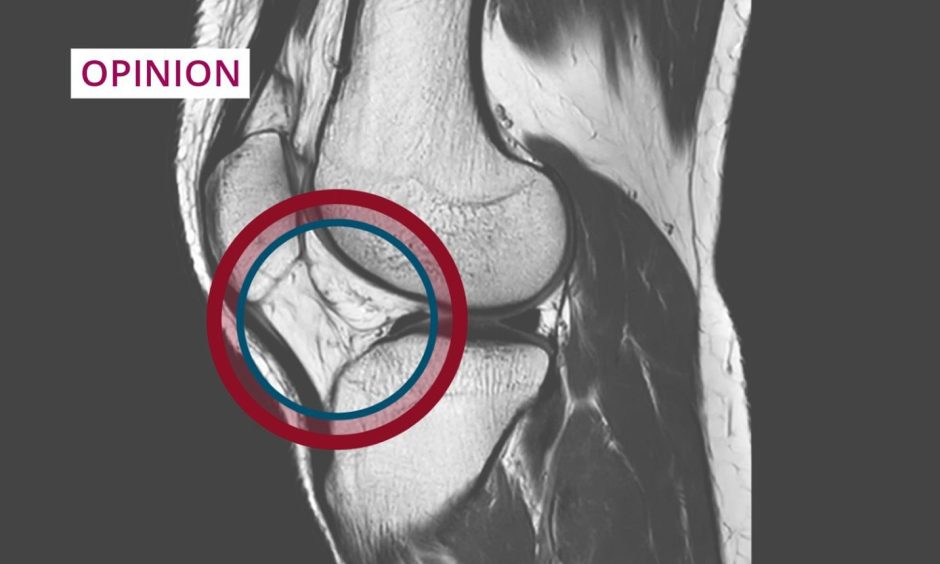 Pictures shows an x-ray of an anterior cruciate ligament (ACL)