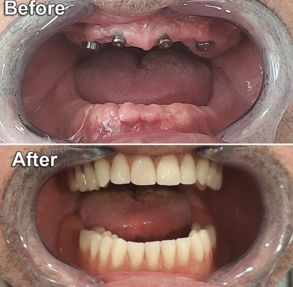 The start and end of a dental implant procedure as shown on both sets of teeth.