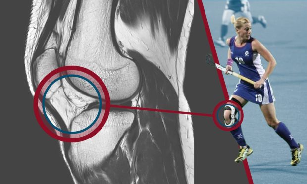 Image shows physiotherapist Aimee Clark alongside a picture of an ACL x-ray