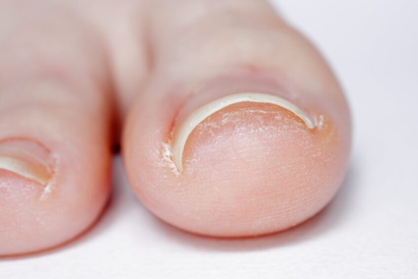 A closeup photo of a big toe.