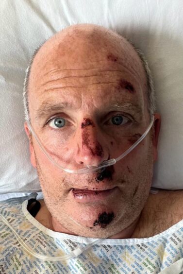 Glenn Campbell, left scarred after his bike accident.