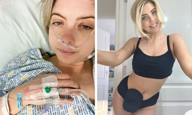 Westhill mother: Bowel condition gave me a ‘Barbie bum’ — and now I love my body