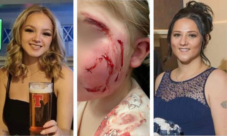 Sarah Simmers, left and Laura Simmers. Centre: the horrific injuries suffered by the child when attacked by the Staffy-cross in Cove, Aberdeen.