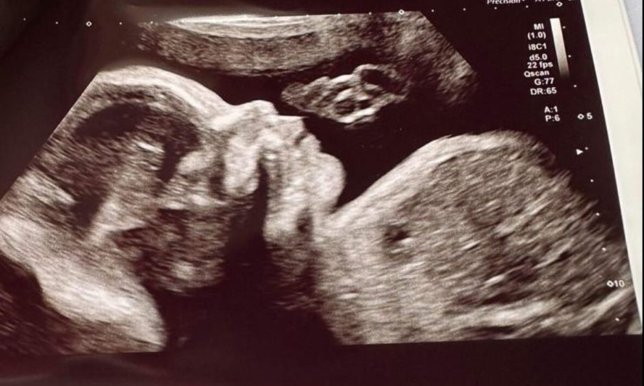 Baby Aiden scan.