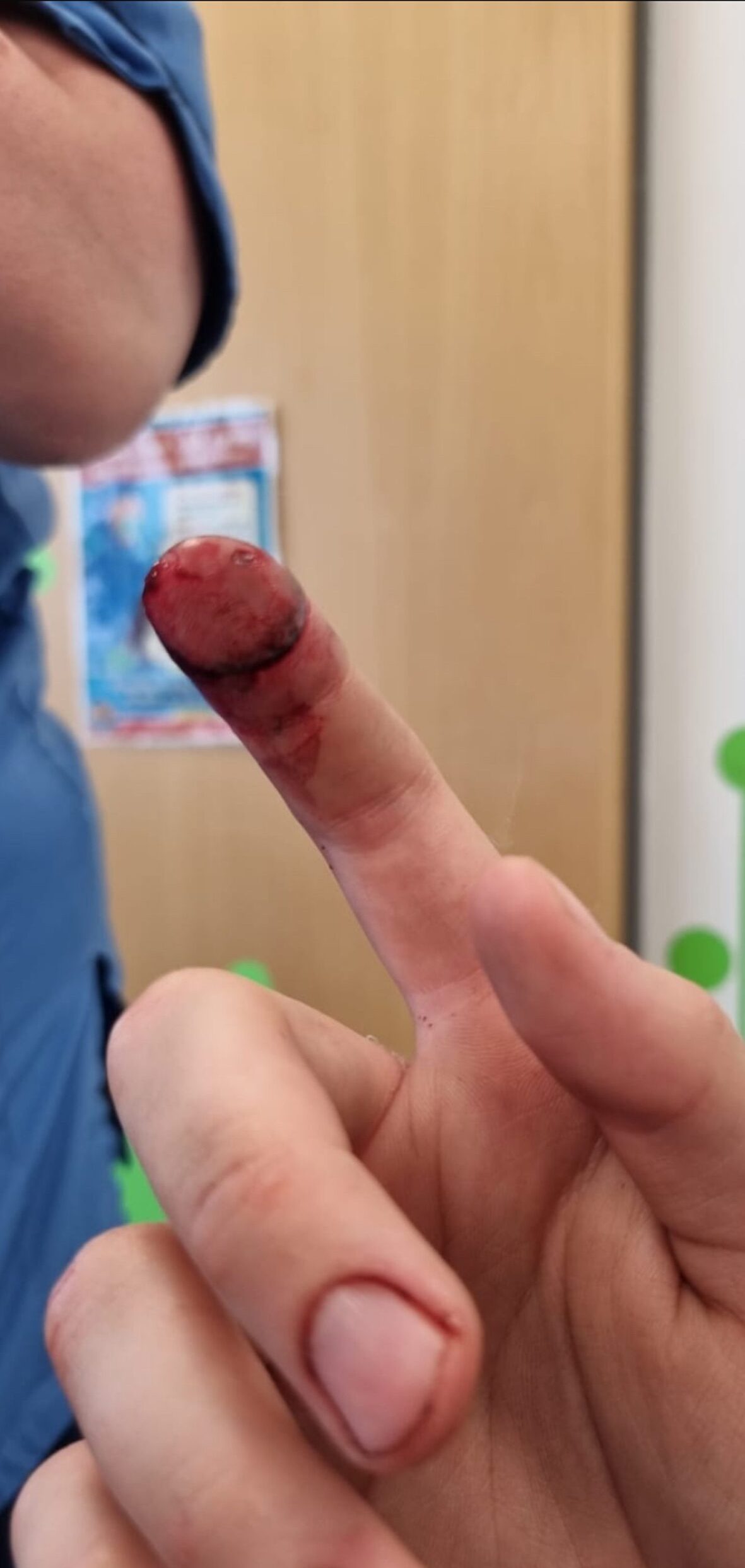 Oliver's injured finger 