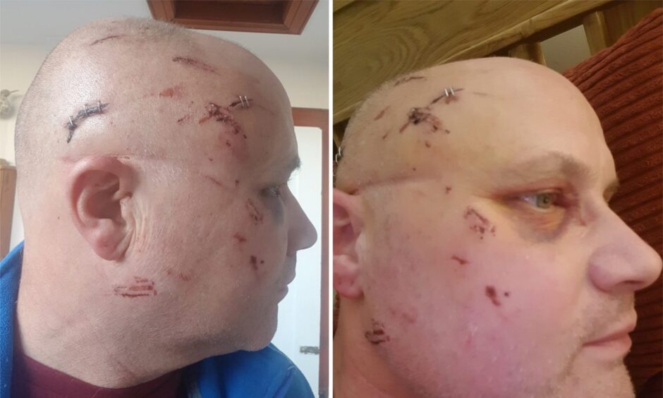 Injuries sustained by Stuart Campbell in Fochabers bus stop assault.