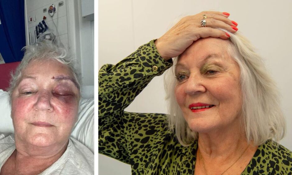 Doreen Adams's black eye after surgery and 16 months later