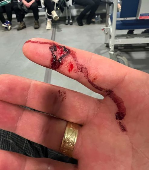 Aberdeen taxi driver finger after assault.