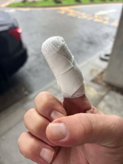 A bandaged finger beloning to Abdullah ER. 