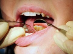 The Scottish Liberal Democrats have warned people are travelling abroad to access dental treatment (Rui Vieira/PA)