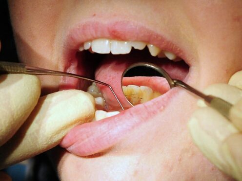 Thousands of children were admitted to hospital with tooth decay last year amid a surge in extractions (Rui Vieira/PA)