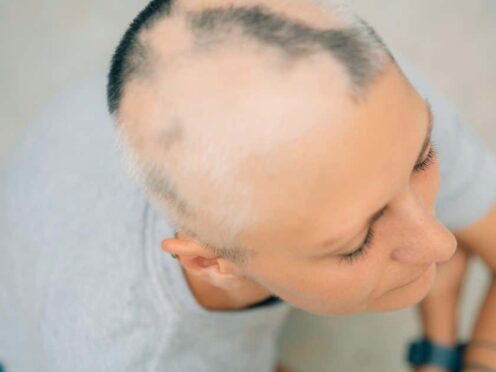 Around 14,000 people with alopecia areata are expected to benefit from the Nice decision (Alamy/PA)