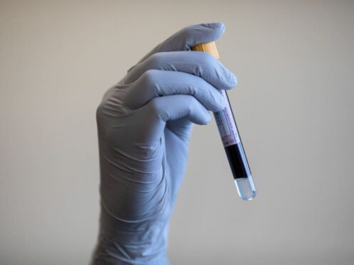A blood test can reveal the presence of prostate cancer (PA)