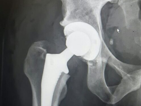 The medical equipment firm makes knee and hip replacements (Stuart Johnson/University of Bristol/PA)