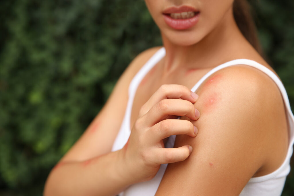Woman scratching shoulder with insect bite outdoors, closeup; 