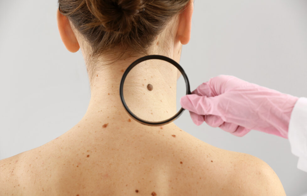 Dermatologist examining moles of patient on light background;