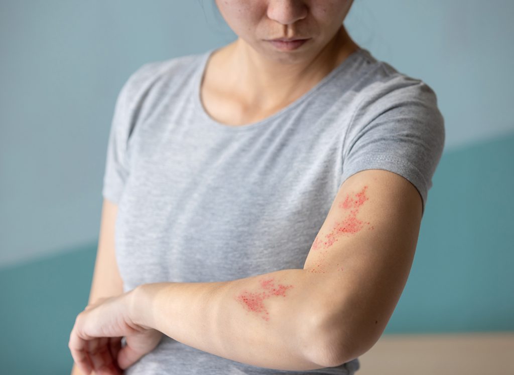 A woman with shingles rash on her arm 