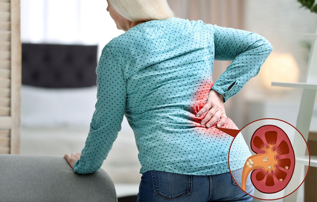 Woman with kidney stones holding back and a small diagram of kidney stones